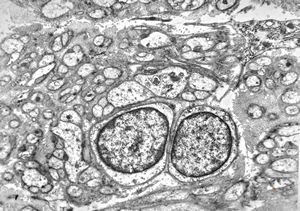 M, 58y. | neurofibroma M, 58y. | neurofibroma